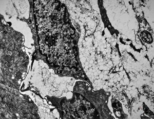 jejunum … lipid malabsorption jejunum … lipid malabsorption